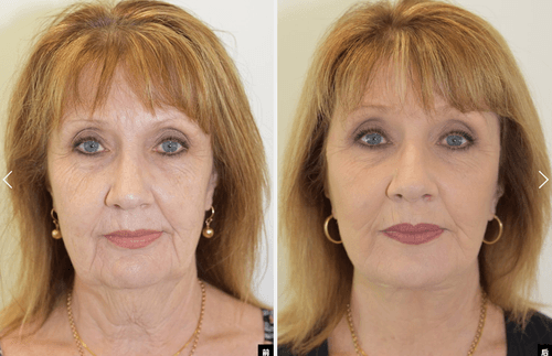 9LFacelift, neck lift, brow lift