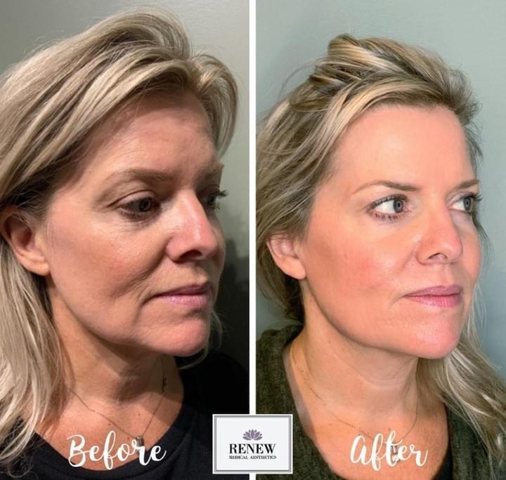 Micro Needling With Radiofrequency