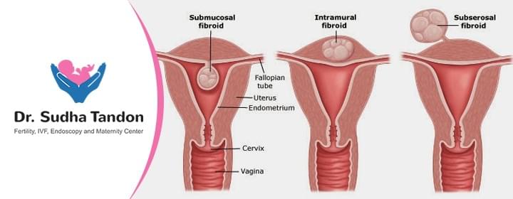 fibroid surgery in mumbai 