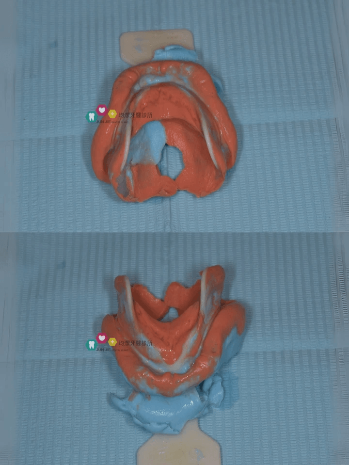 蔡俊宏醫師-吸附式活動假牙口內模型