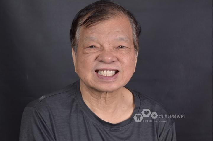 蔡俊宏醫師吸附式活動假牙案例