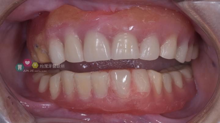 舊活動假牙不夠密合，咬合有問題