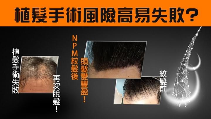HK01報導：脫髮治療 想增加髮量要點揀？植髮手術 VS 專利NPM紋髮