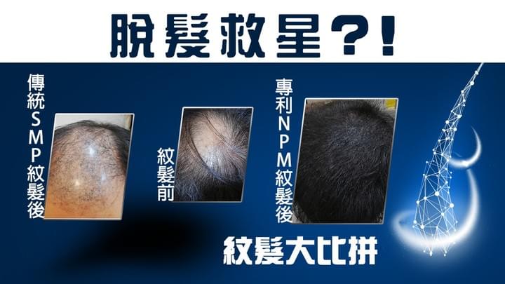 HK01報導【脫髮】解構紋髮技術　專利NPM紋髮 VS 傳統SMP紋髮