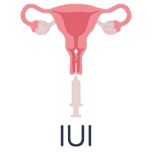 Intrauterine insemination (IUI)