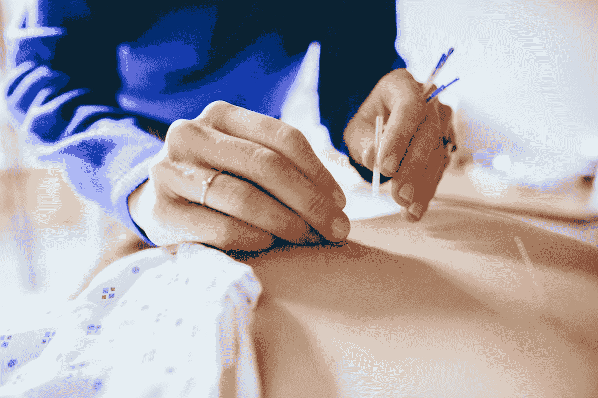 Acupuncture treatment Acupuncture treatment