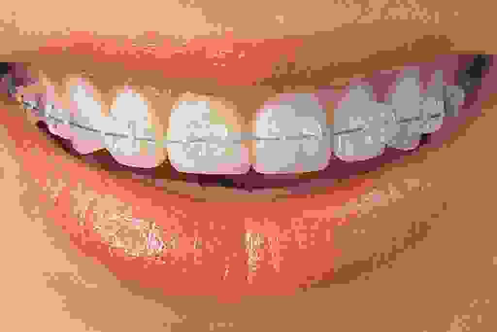 Factors Influencing Orthodontic Costs in Dubai Health