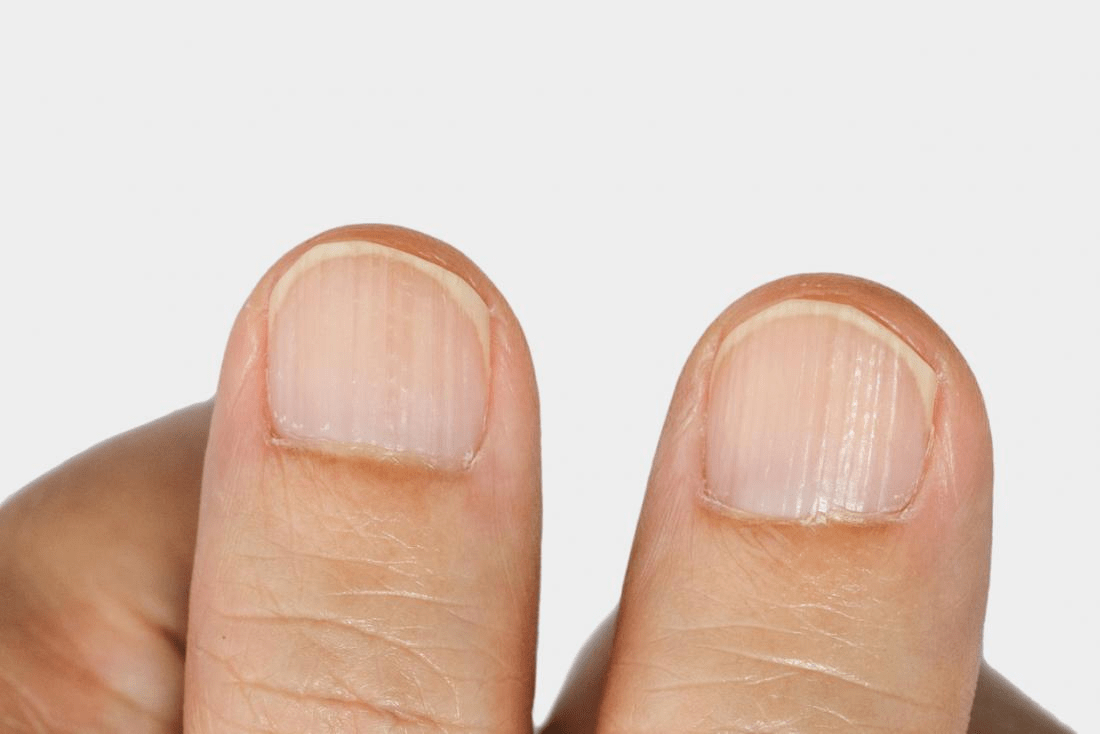 Fingernails odd spreading of white area