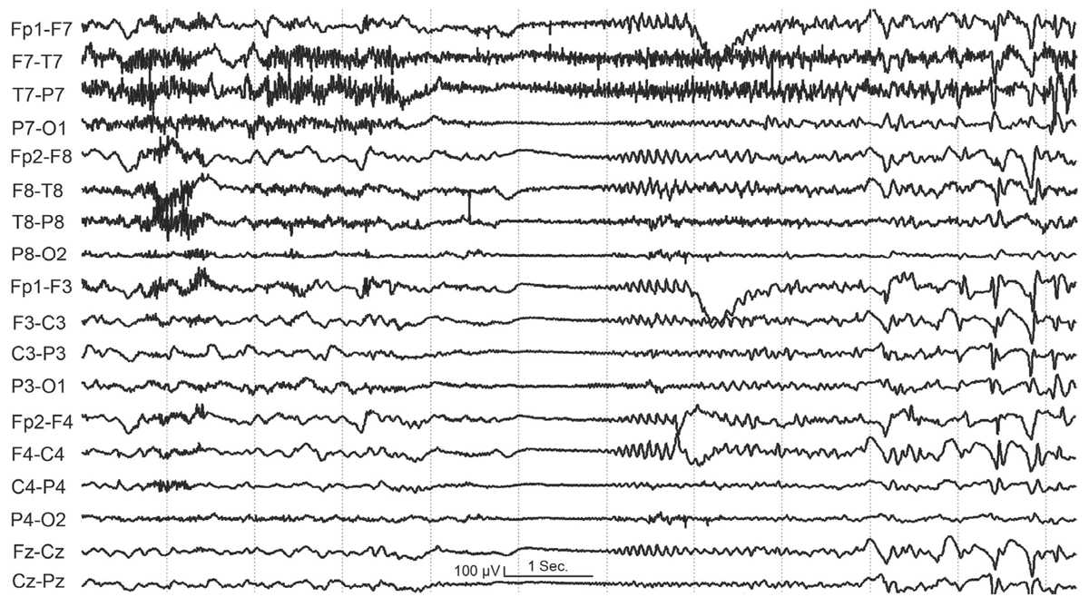 Normal vs epilepsy eeg