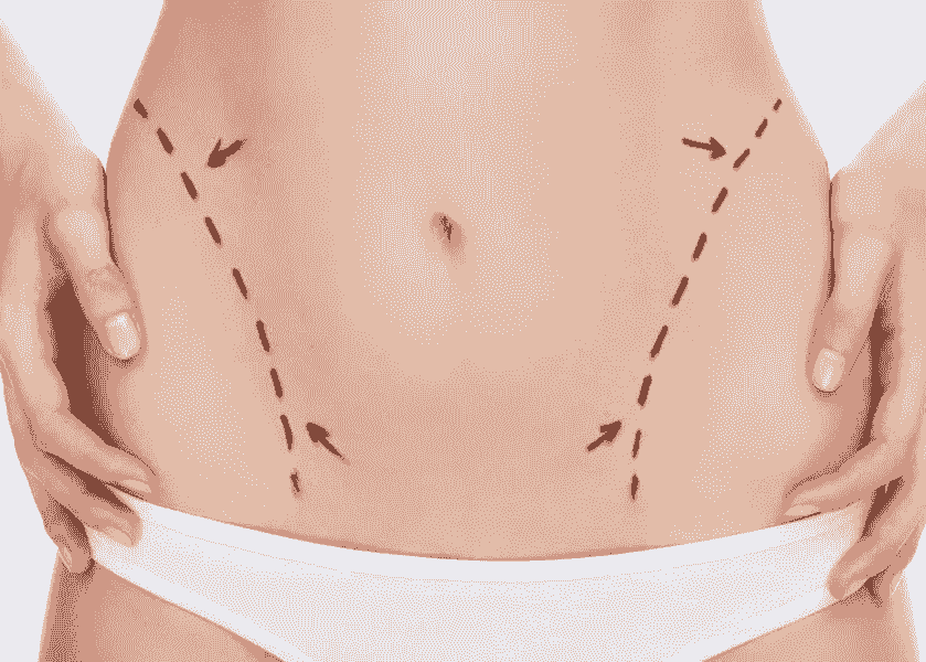 Preparing for Your Tummy Tuck Essential Steps for Duba...