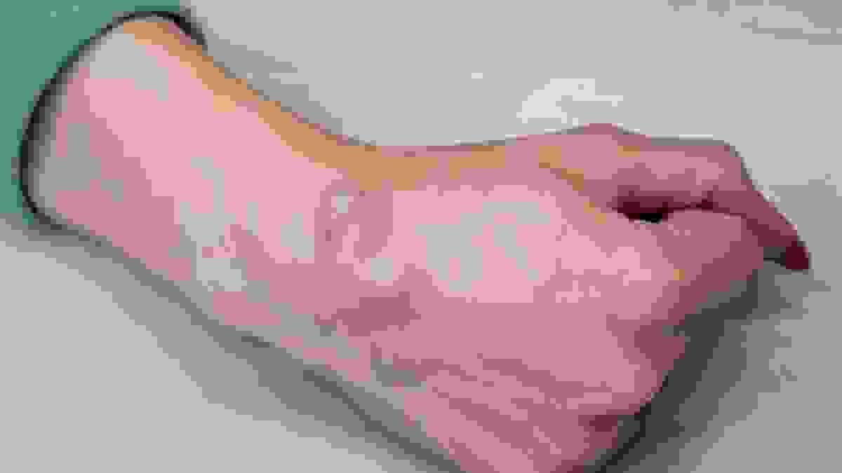 Understanding Ganglion Cysts and Their Potential Link t...