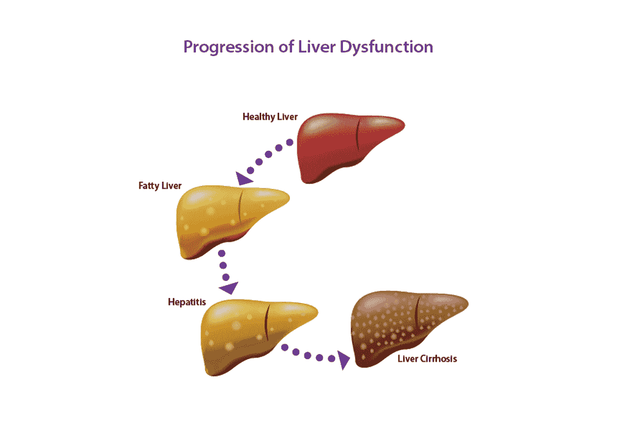 肝功能異常的各個階段 肝功能異常的各個階段