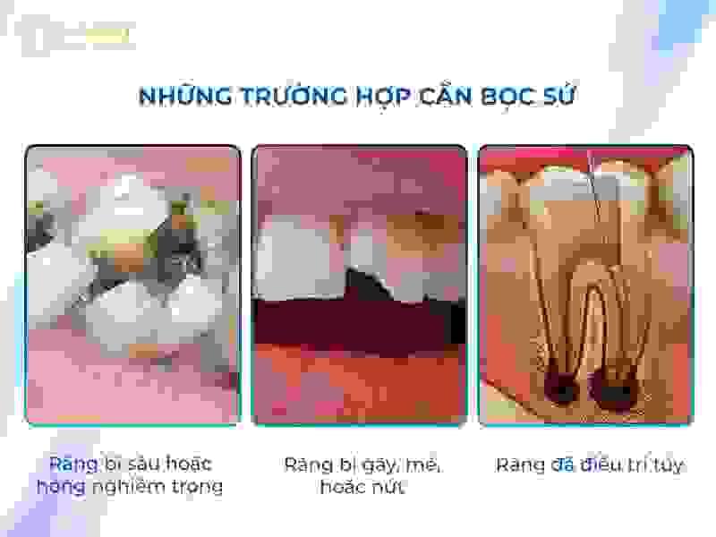 Những trường hợp cần bọc sứ