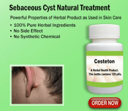 Natural Treatment for Sebaceous Cyst