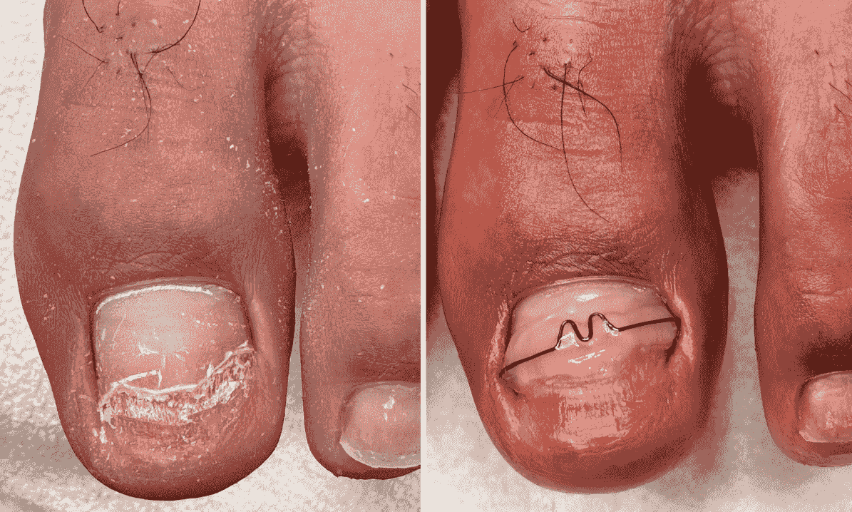 耐恩適維持器-合作店家案例-劉先生 耐恩適維持器-合作店家案例-劉先生