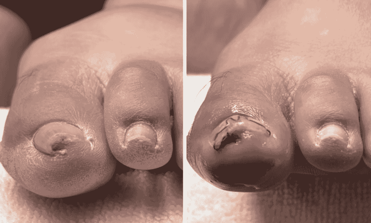 耐恩適維持器-合作店家案例-李小姐 耐恩適維持器-合作店家案例-李小姐