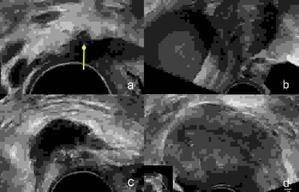 Endometriose-Diagnostik Ultraschall Bern GynaeXcellence Endometriose-Diagnostik Ultraschall Bern GynaeXcellence