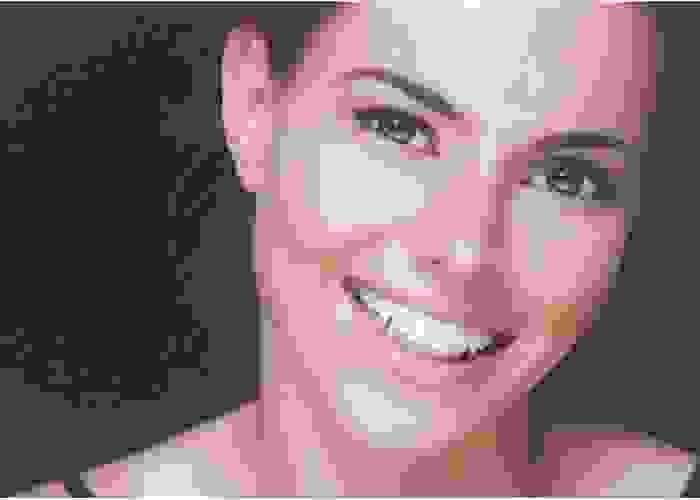 Tooth Reshaping Simple, Subtle & Effective