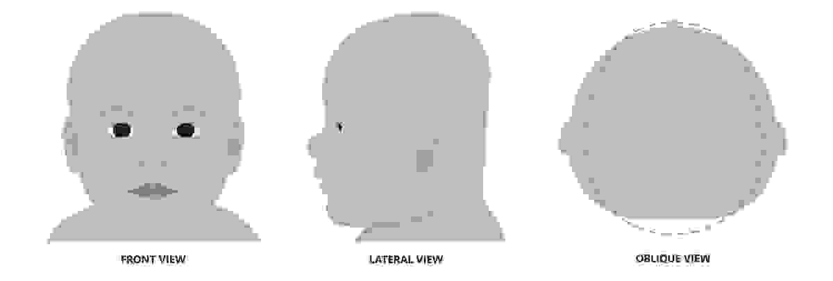 Brachycephaly Brachycephaly