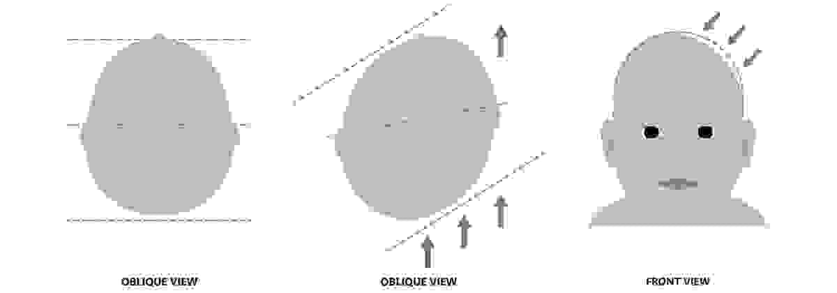 Plagiocephaly Plagiocephaly