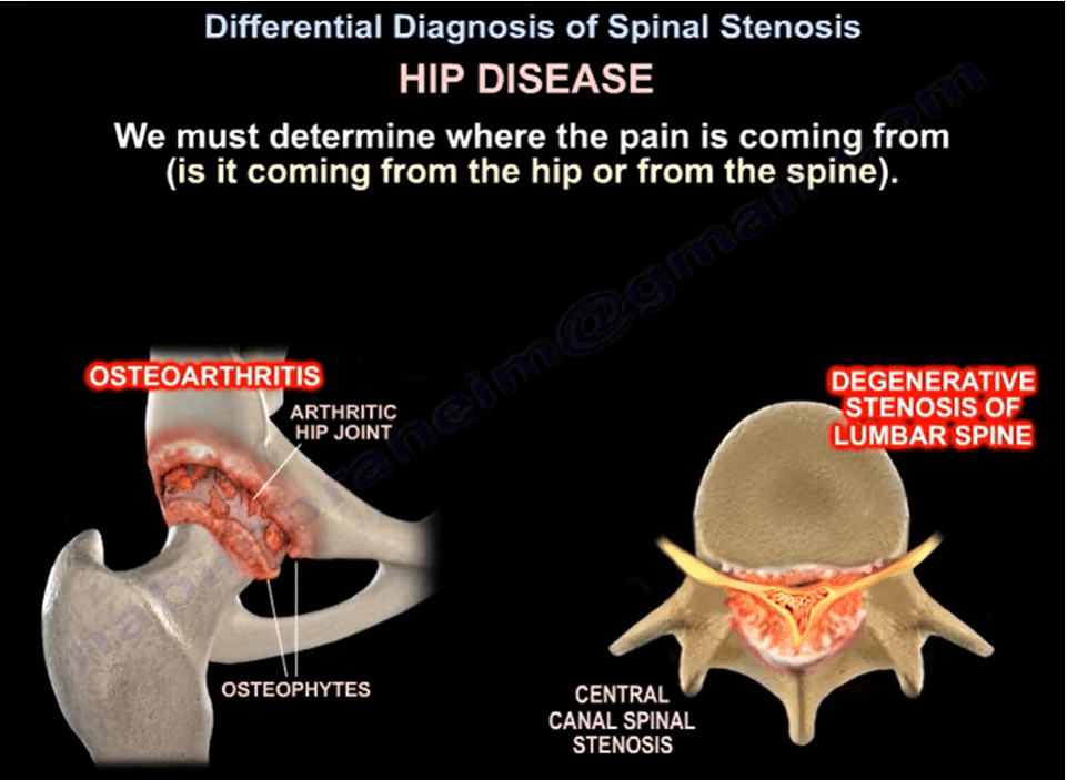Differential Diagnosis for Spinal Stenosis