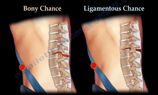 Chance Fractures of the Spine - Healthcare Fractures ca...