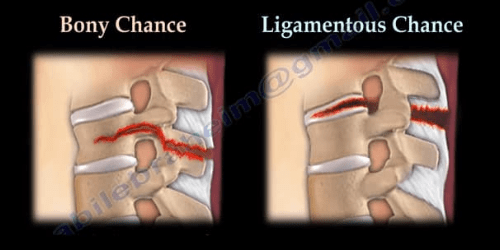 Chance Fractures of the Spine - Healthcare Fractures ca...