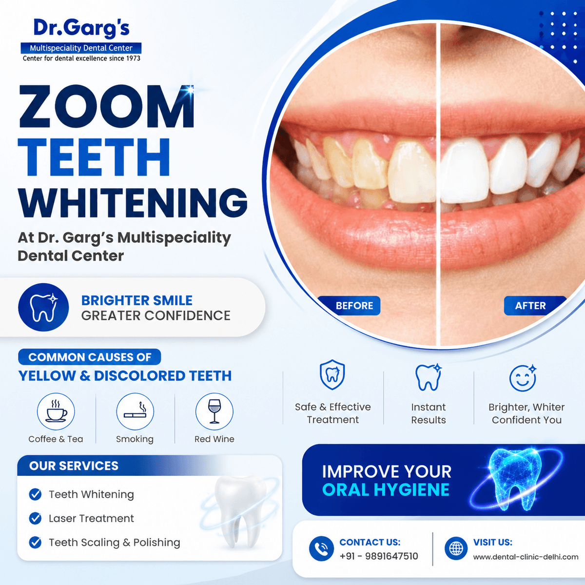 zoom whitening service delhi