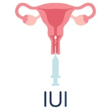 Intrauterine insemination (IUI)