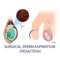 Surgical sperm aspiration (PESA/TESA)