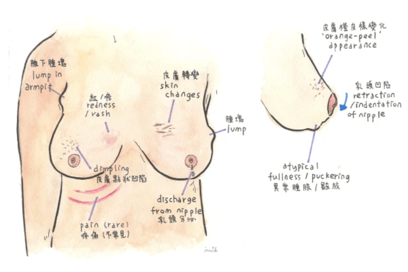 留意有否出現這些症狀