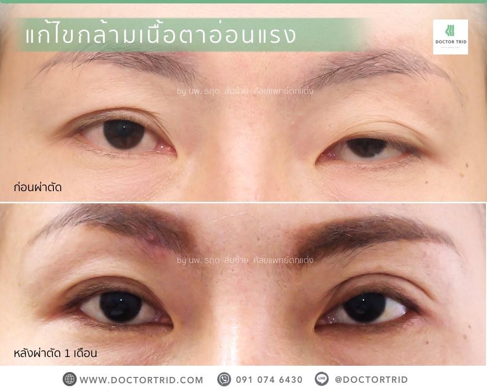 แก้ไขกล้ามเนื้อตาอ่อนแรง