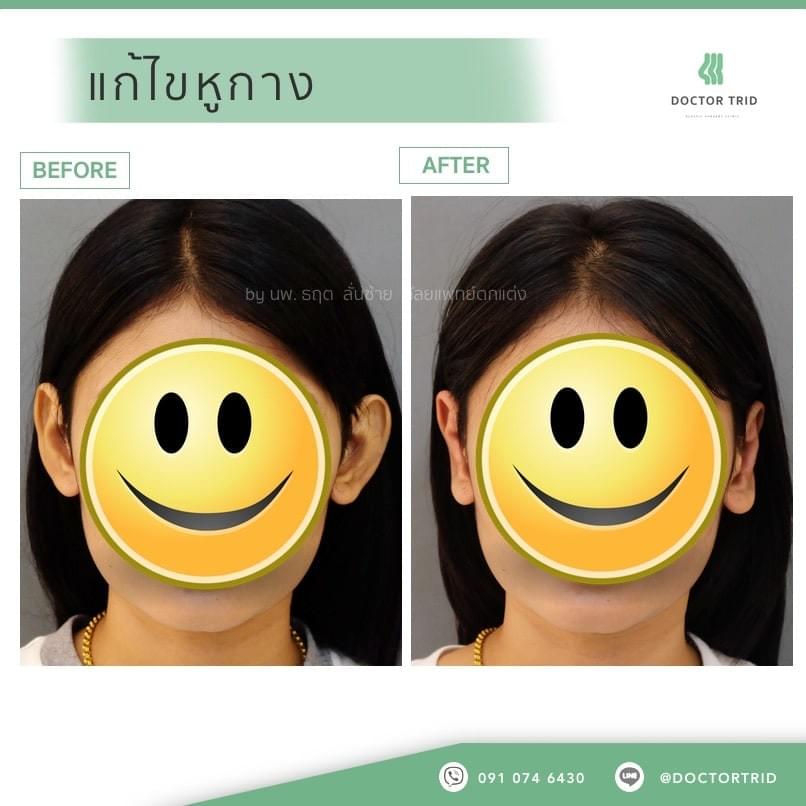 ภาพการแก้ไขหูกาง