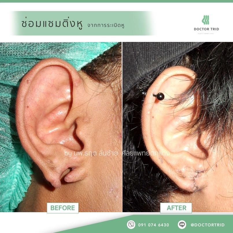 ภาพการผ่าตัด ซ่อมแซมติ่งหู
