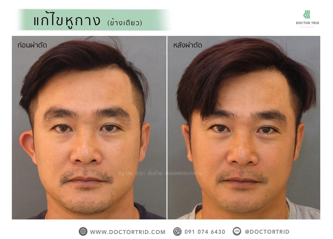 ภาพการผ่าตัด แก้ไขหูกาง