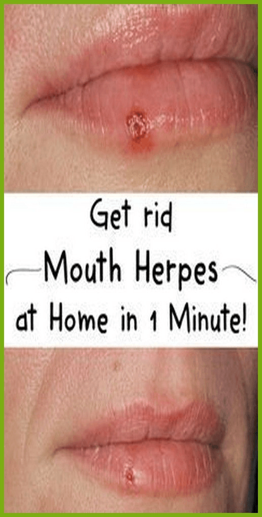 Can you get herpes from touching