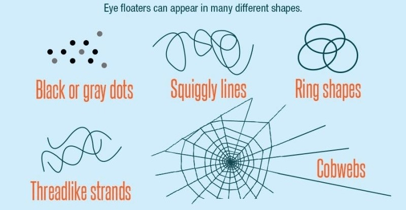 Retina Visual Floaters after retina surgery