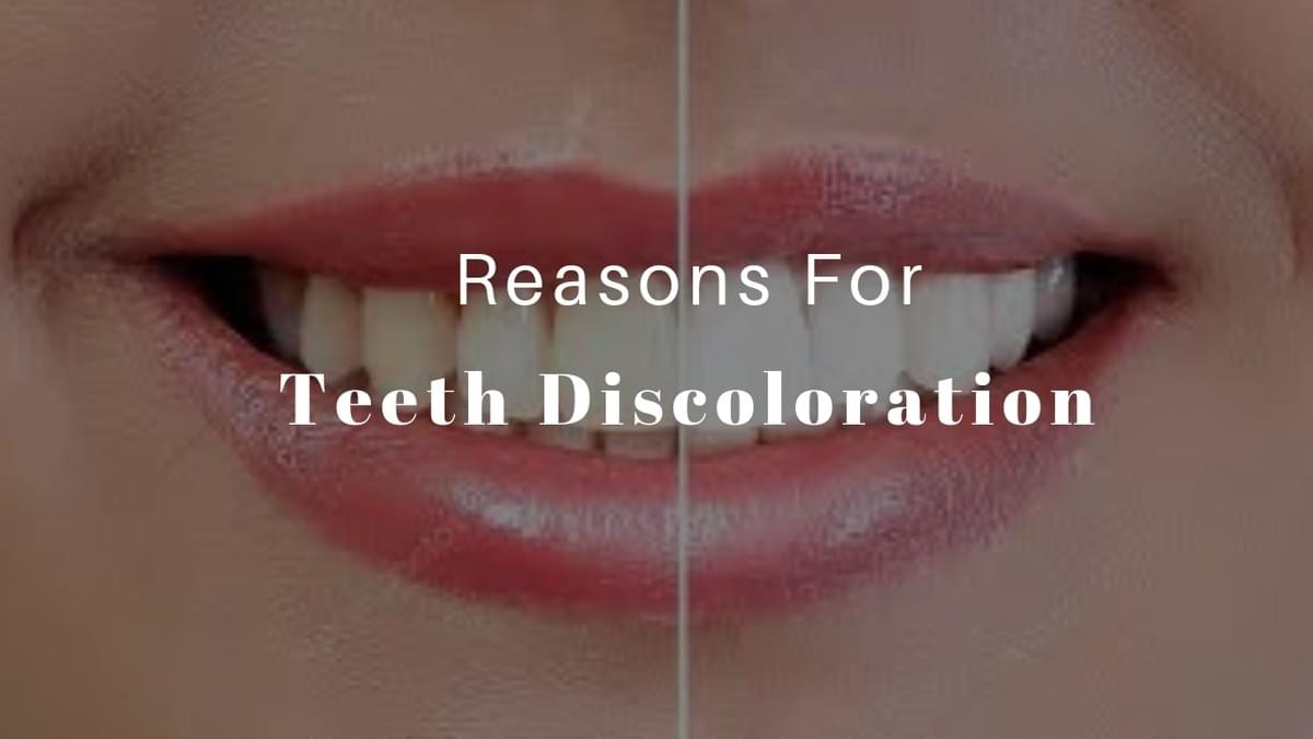 Reasons For Teeth Discoloration Dentist