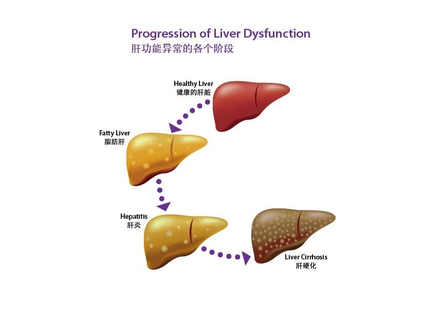 肝功能異常的各個階段