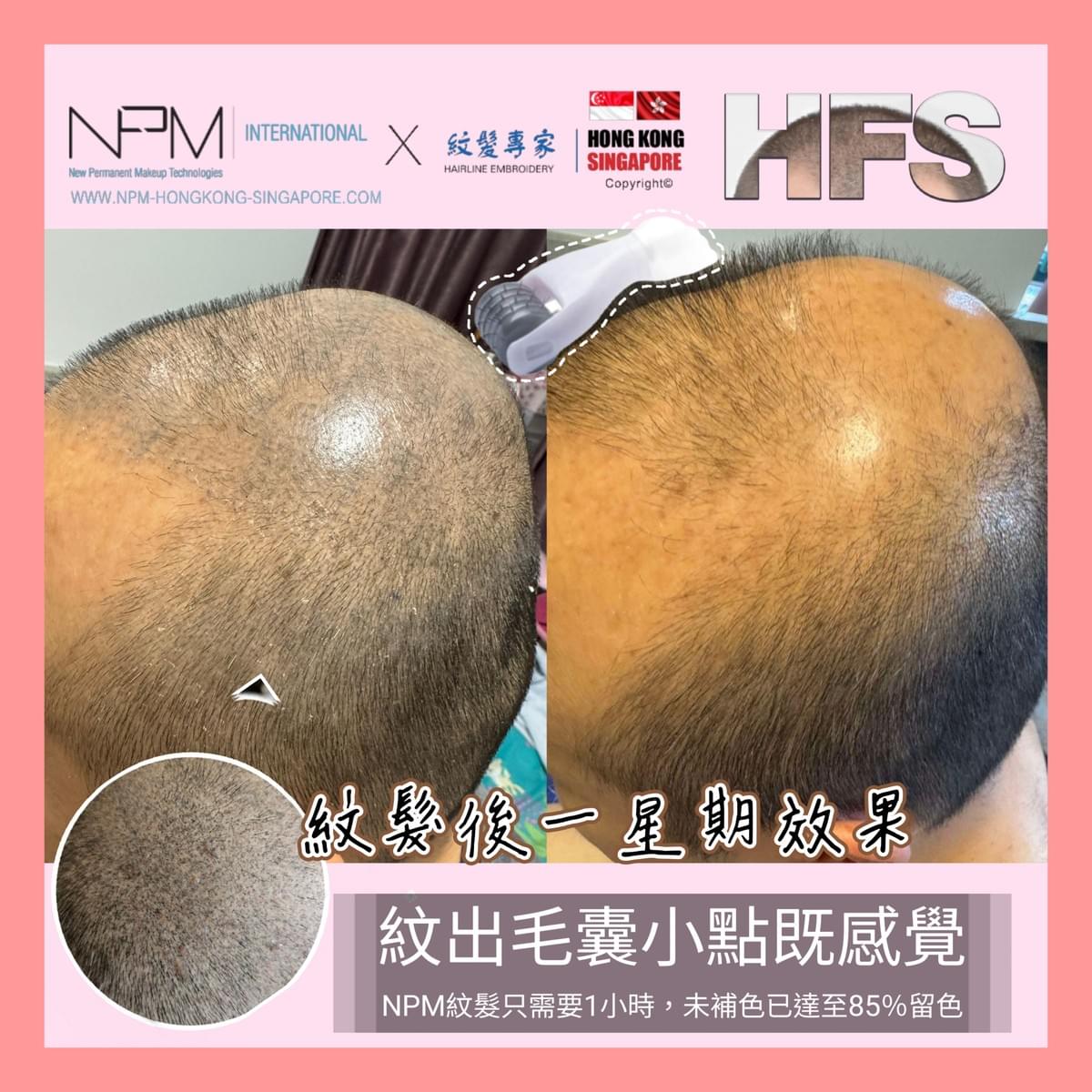 SMP單針技術與NPM滾輪技術對比｜紋髮技術差異