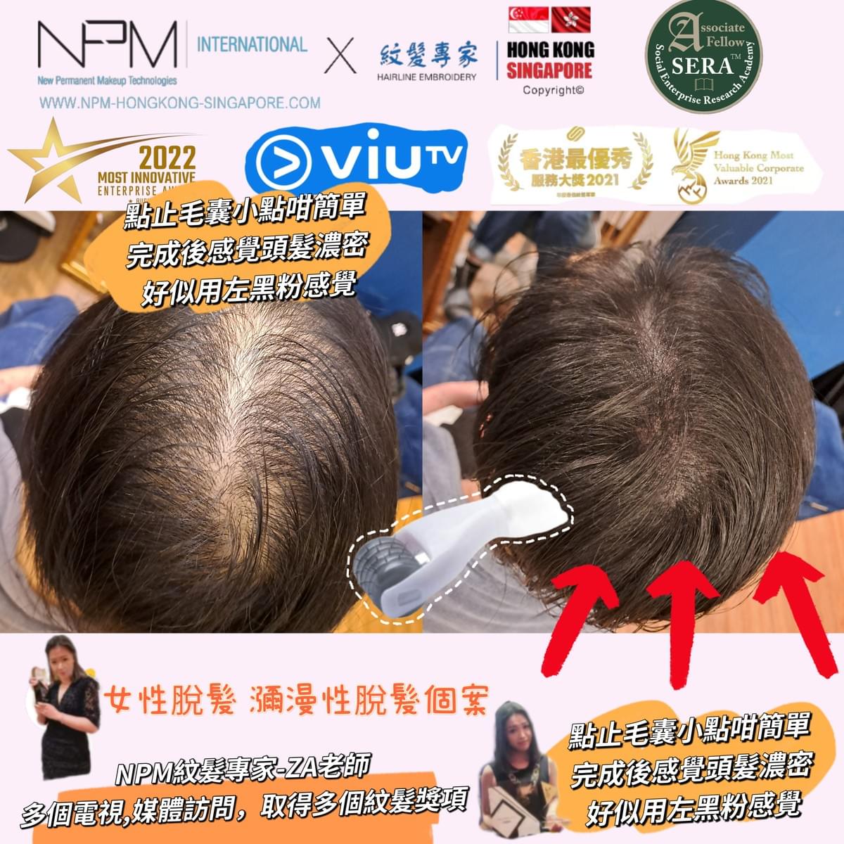 產後脫髮怎麼辦？｜ 壓力性脫髮的改善方式｜無創紋髮技術｜自然濃密效果