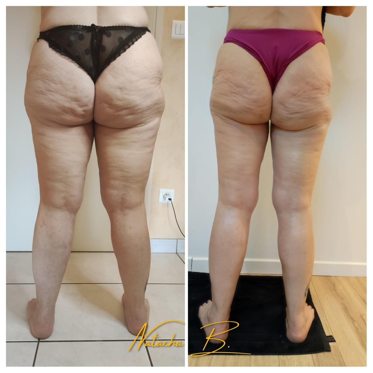 drainage lymphatique perte de cm jambe et peau sans cellulite dans l'ain