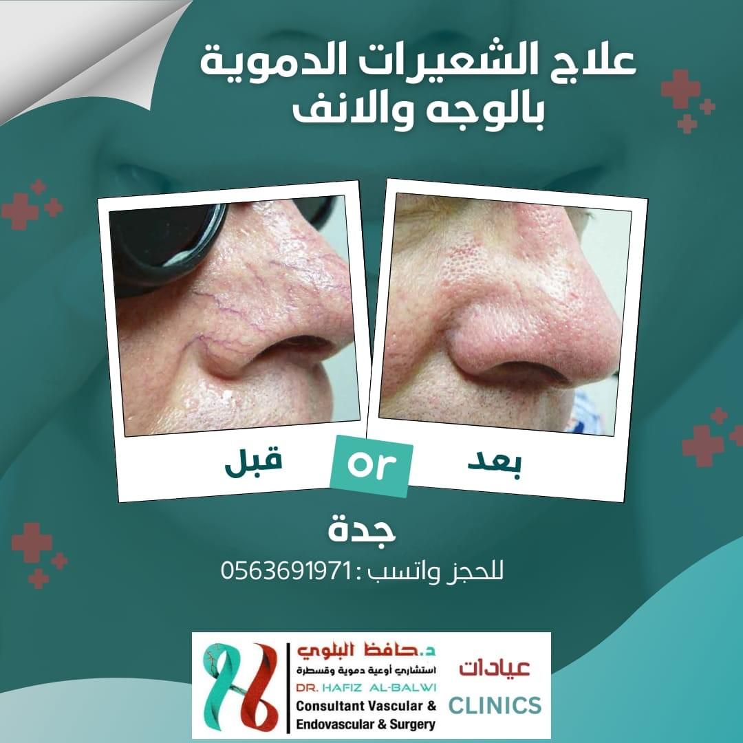 علاج الشعيرات الدموية بالوجه والأنف