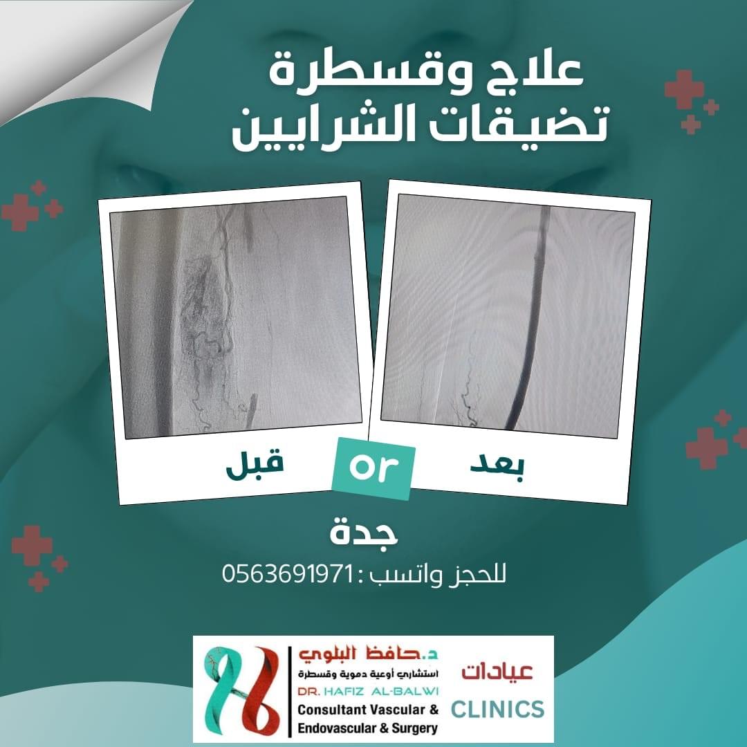 علاج تضيق الشريان 
