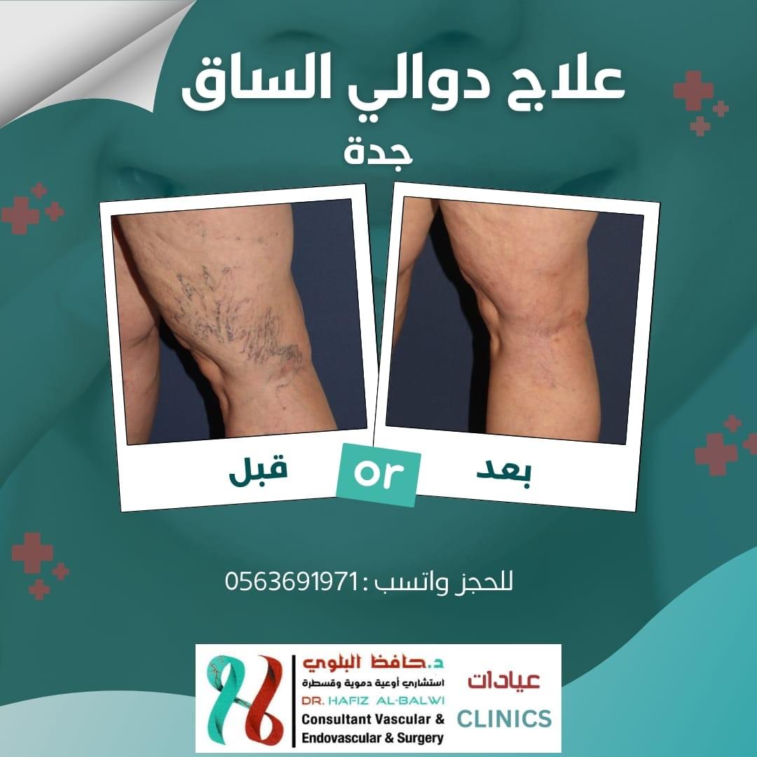 علاج الدوالي بالحقن التصليب