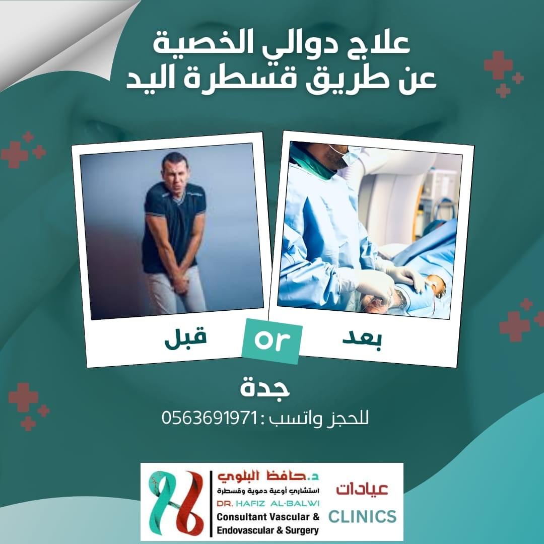 علاج دوالي الخصية بالقسطرة