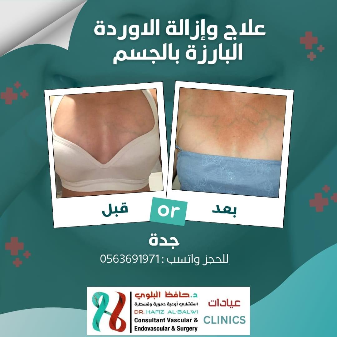 علاج الاوردة والشعيرات الدموية بالجسم والصدر