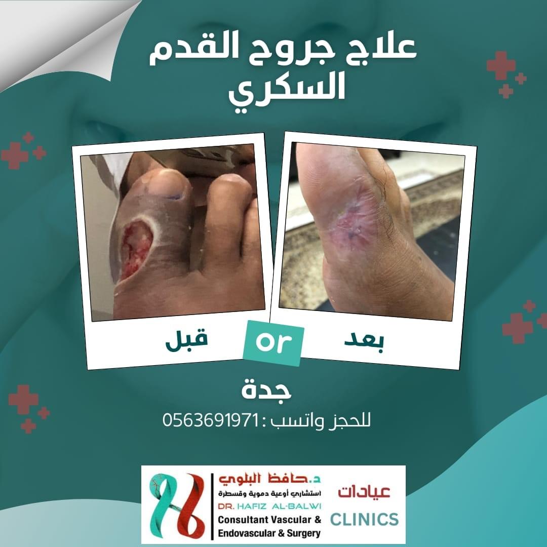 علاج الغرغرينا والقدم السكري