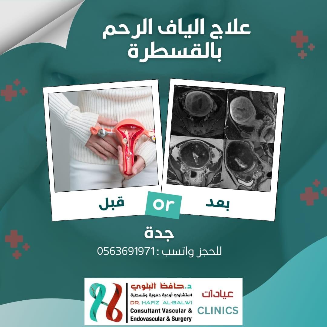 علاج الياف الرحم بالقسطرة