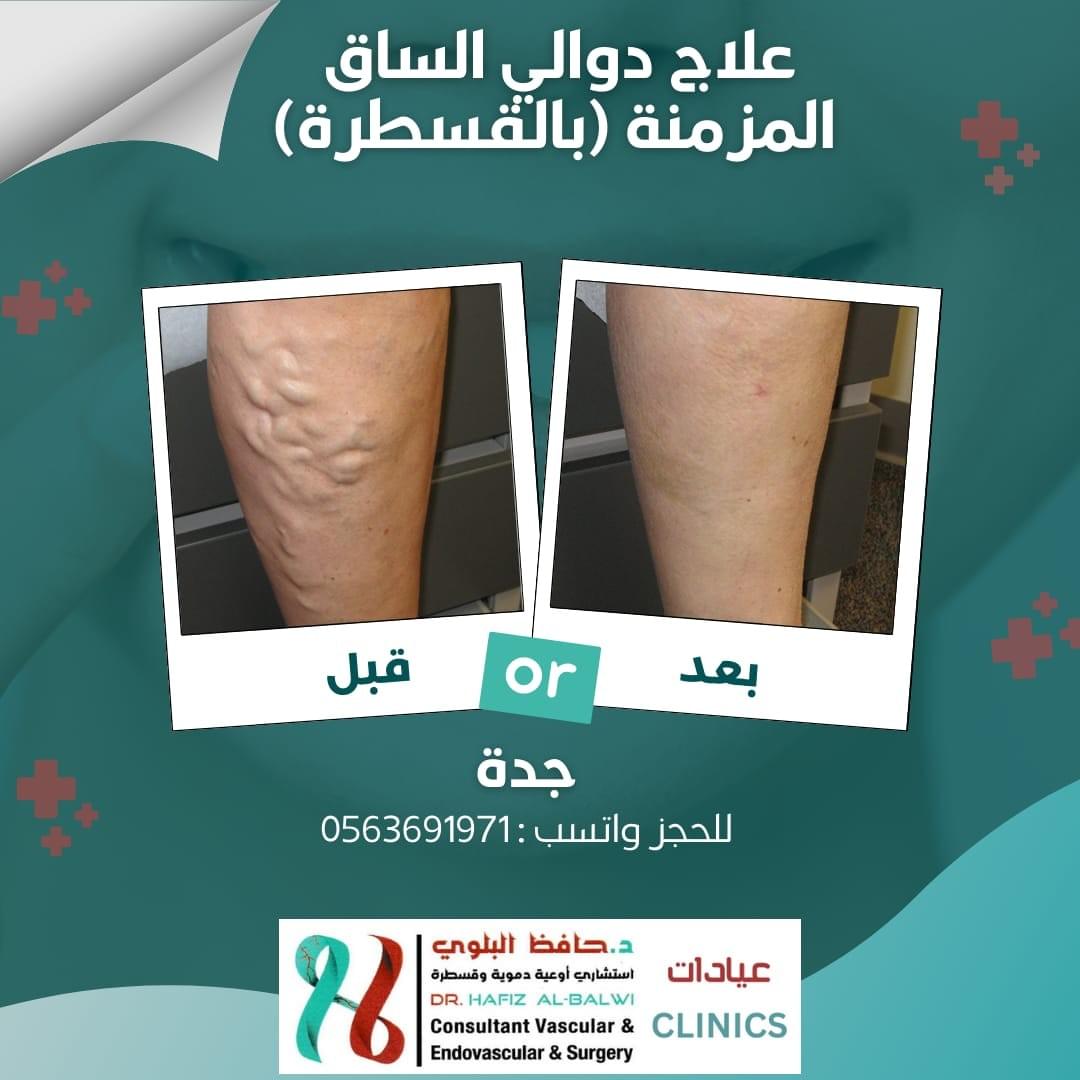 قسطرة الليزر لعلاج دوالي الساق